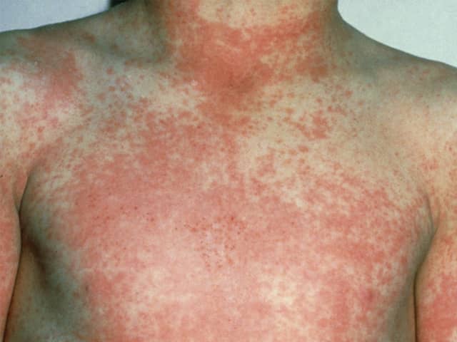 After 12 to 48 hours the characteristic fine red rash of scarlet fever develops