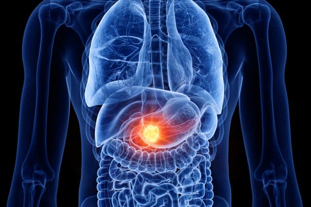 Here are signs of pancreatic cancer you can look out for