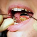 Dentists in Blackpool removed teeth from a record number of children in the last year