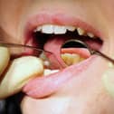 Dentists in Blackpool removed teeth from a record number of children in the last year