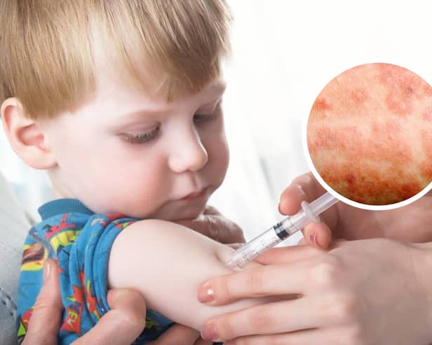 Measles cases are on the rise - and health officials fear many children are not vaccinated against it. (Picture: RCPCH and NHS)