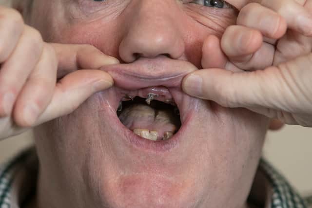 David had just tucked into a sandwich while on holiday in Blackpool when he felt a sharp pain in his gums (Credit: Lee McLean / SWNS)