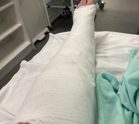 Rebecca will need to undergo surgery to treat her dislocated ankle