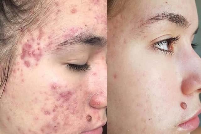 A client's before and after journey to their dream skin.