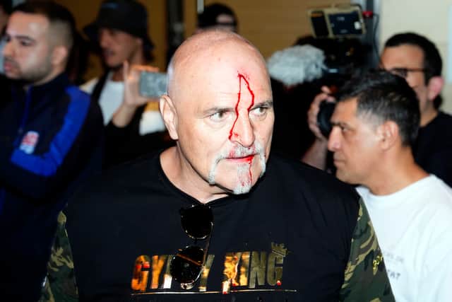 John Fury, father of boxer Tyson Fury, with blood on his face during a media day in Riyagh. Credit: PA