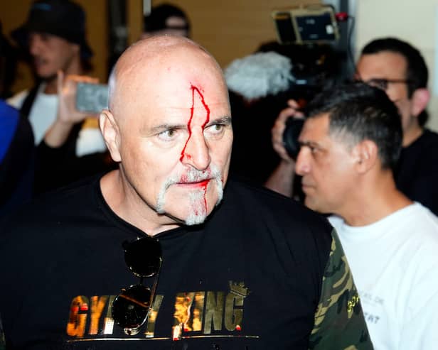 John Fury, father of boxer Tyson Fury, with blood on his face during a media day in Riyagh. 
