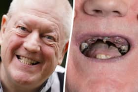 Ex-miner celebrates getting new teeth after living on diet of soup and painkillers