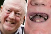 Ex-miner celebrates getting new teeth after living on diet of soup and painkillers