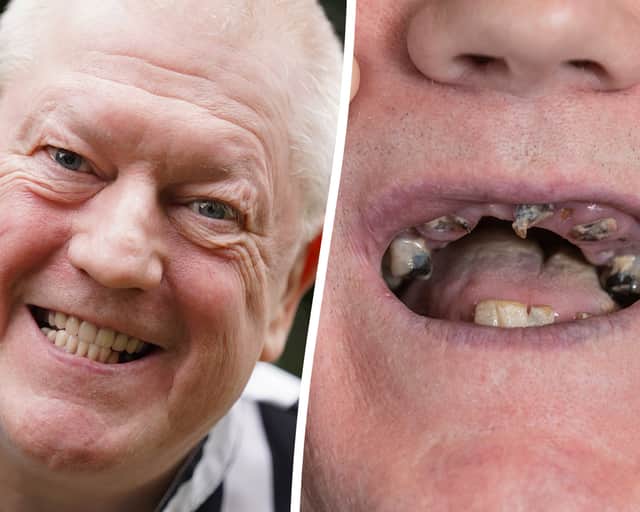 Ex-miner celebrates getting new teeth after living on diet of soup and painkillers