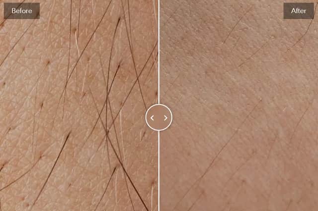 Keskine IPL hair removal device (£199 was £299)