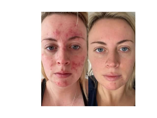 Customers share amazing before and after results of skincare brand that took the world by storm - Abigail's results 47 Skin 