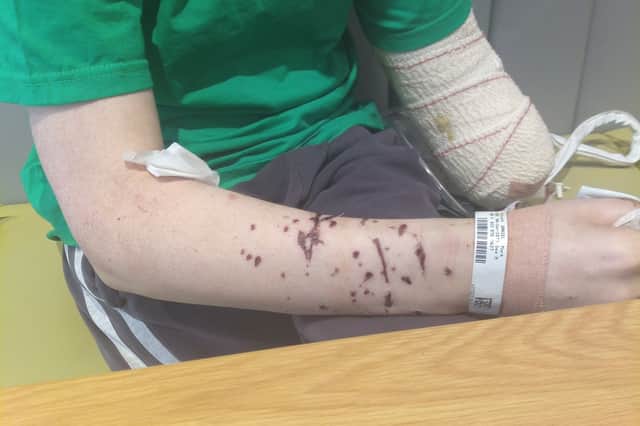Mark Daniel lost his left arm below the elbow, as well as part of his ear in the attack