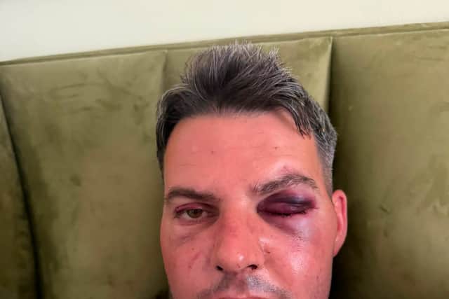 Chris Simpkins suffered injuries to his face