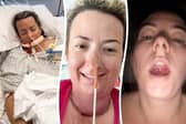 Mum Lisa Martin, 47, from Thornton thought the lump in her throat was down to a lingering cold - but it was actually a hidden sign she has tongue cancer