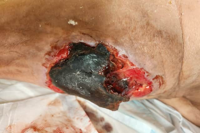 Martin Jones  said it was believed the badly infected wound to his wife's leg was likely to have been caused by a bite by a False Widow spider