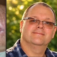 My wife endured a horrific skin infection after suspected spider bite in Blackpool - and  still needs help