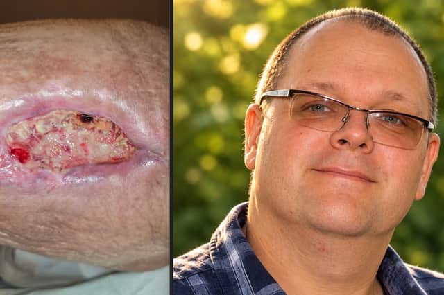Martin Jones  said it was believed the badly infected wound to his wife's leg was likely to have been caused by a bite by a False Widow spider