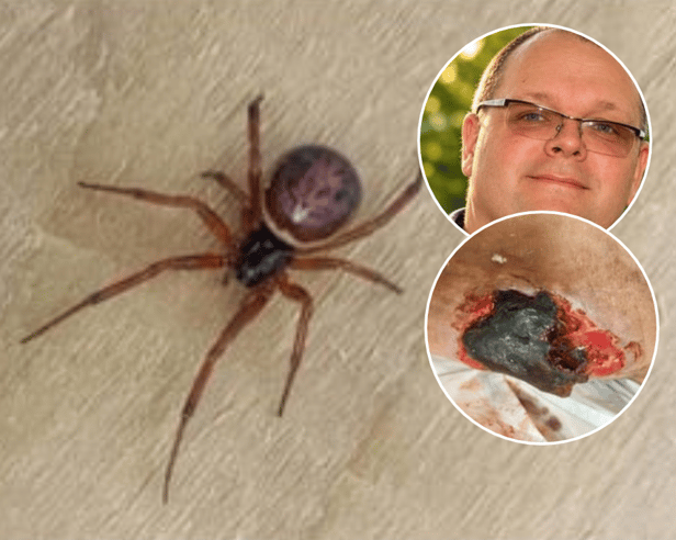 Martin Jones (inset)  said it was believed the badly infected wound to his wife's leg (inset)  was likely to have been caused by a bite by a False Widow spider