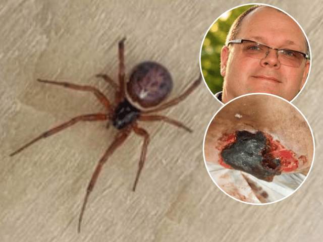 Martin Jones (inset)  said it was believed the badly infected wound to his wife's leg (inset)  was likely to have been caused by a bite by a False Widow spider