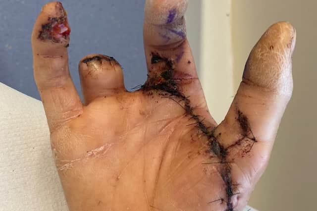 Chris Pawson's hand following the workplace accident that left him with two missing fingers. // A young dad has been awarded a "seven figure" pay out after his life was ruined by a horrific workplace saw accident - that left him with two missing fingers. Chris Pawson, 38, had a successful career as a self-employed joiner working on makeovers for some of the UKÕs best-known high street food chains. But his life changed forever when his right hand was dragged into a lethal spinning blade after a colleague failed to set up a saw properly. His middle finger disappeared completely and his ring finger was partially amputated while his thumb and index finger were left with extensive nerve, muscle and tendon damage.