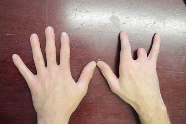 Chris Pawson's hand following the workplace accident that left him with two missing fingers. // A young dad has been awarded a "seven figure" pay out after his life was ruined by a horrific workplace saw accident - that left him with two missing fingers. Chris Pawson, 38, had a successful career as a self-employed joiner working on makeovers for some of the UKÕs best-known high street food chains. But his life changed forever when his right hand was dragged into a lethal spinning blade after a colleague failed to set up a saw properly. His middle finger disappeared completely and his ring finger was partially amputated while his thumb and index finger were left with extensive nerve, muscle and tendon damage.