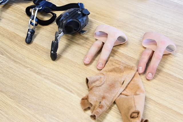 Chris Pawson's prosthetics. // A young dad has been awarded a "seven figure" pay out after his life was ruined by a horrific workplace saw accident - that left him with two missing fingers. Chris Pawson, 38, had a successful career as a self-employed joiner working on makeovers for some of the UK’s best-known high street food chains. But his life changed forever when his right hand was dragged into a lethal spinning blade after a colleague failed to set up a saw properly. His middle finger disappeared completely and his ring finger was partially amputated while his thumb and index finger were left with extensive nerve, muscle and tendon damage.
