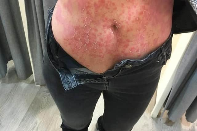 Paula Taylor when she had severe psoriasis