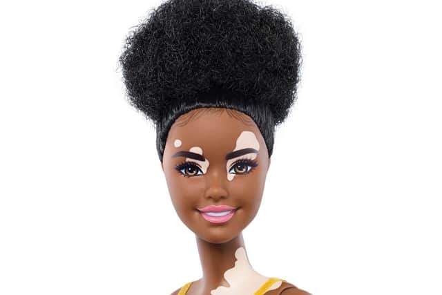 Barbie doll with the skin condition vitiligo
