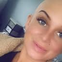 Robyn Bridge, 27, who grew up in Blackpool, developed alopecia when she was just two-years-old. She shaved her head this summer after her hair loss worsened.