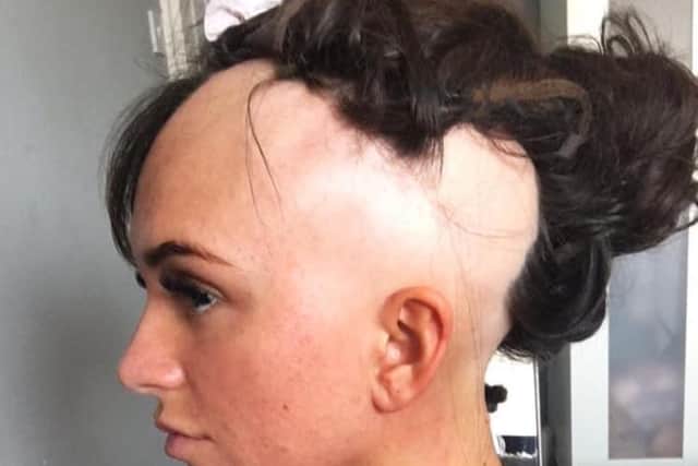 Robyn Bridge hopes to raise awareness of alopecia.