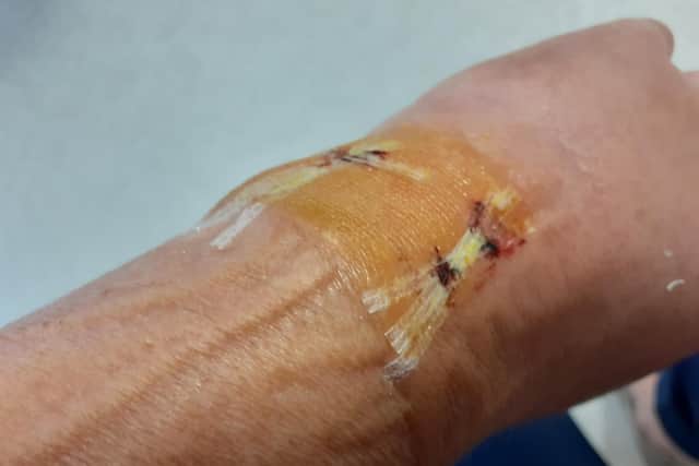 The bite wounds to one of the women attacked by a dog in Thornton