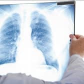 A file image of a doctor looking at a chest X-ray (Picture: PA Photo/thinkstockphotos)