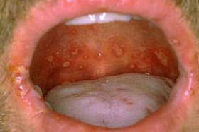 Mouth ulcers are a telltale sign of hand, foot, and mouth disease