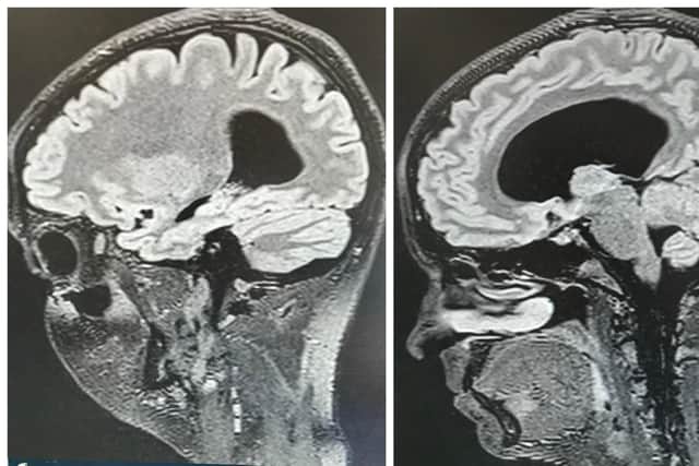On the images it shows what a person's brain should look like on the left compared to Emma's on the right