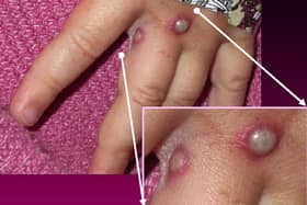 Cases of monkeypox has been found in Blackpool (Photo courtesy of CDC/Getty Images)