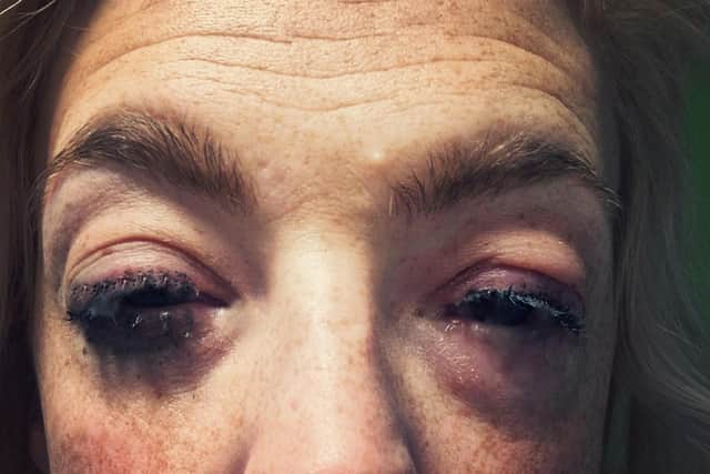 Miranda Bury was left with black eyes at one point during the relationship  