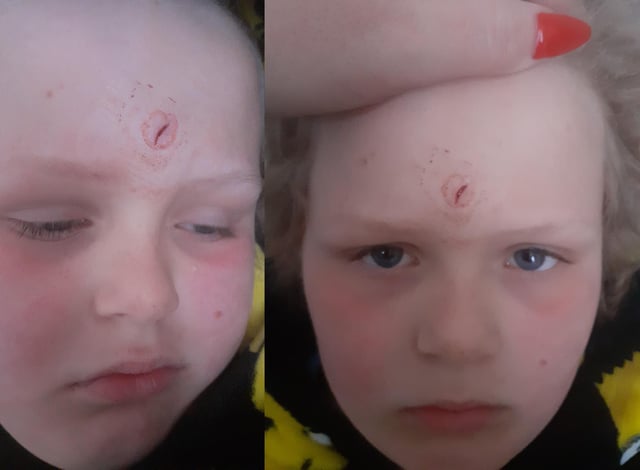 Harry suffered a cut to his forehead after an empty lighter fluid can was thrown at him