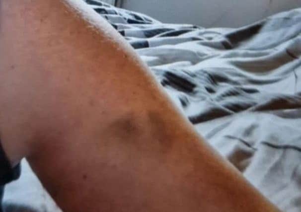 Injuries Miranda Bury sustained during the relationship