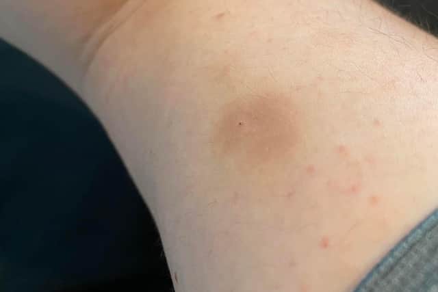 Sam Durning feared he might have been 'spiked by needle' after blacking out on a night out in Lytham and finding a jab mark on his arm the next morning