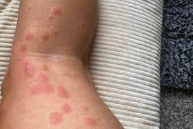 Marian and Sharon say they were each left with more than 200 bites on their bodies, causing nasty rashes to spread across their arms, legs, feet and faces.