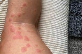 Marian and Sharon say they were each left with more than 200 bites on their bodies, causing nasty rashes to spread across their arms, legs, feet and faces.