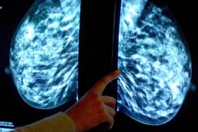 Thousands of women in Blackpool are missing breast scan appointments