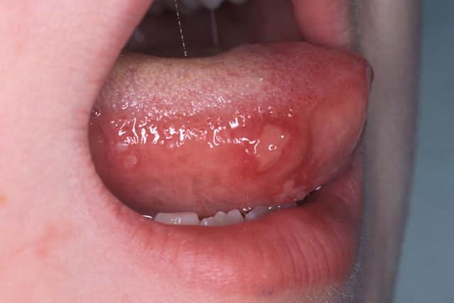 After a few days mouth ulcers and a rash will appear. Ulcers appear in the mouth and on the tongue and these can be painful and make it difficult to eat or drink
