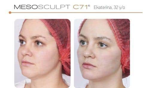Photo of Ekaterina before and after Mesosculpt C71