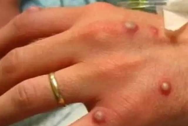 Two cases cases of suspected monkeypox were reported in Blackpool