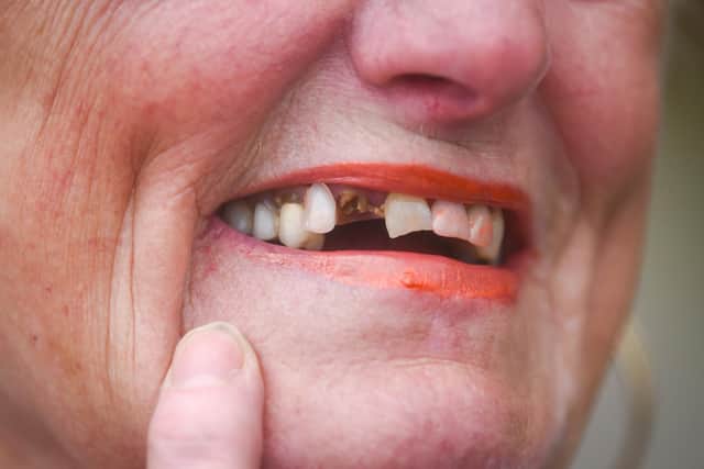 Barbara Terry, who lost a tooth after a supporting post broke,  has been told she could have to wait 14 weeks for a dental appointment