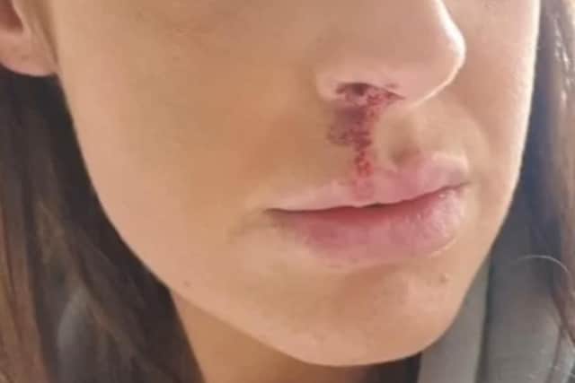 Injuries Miranda Bury sustained during abusive relationship with Joshua Carney