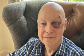 Robert Foster was attacked by a gull while walking his dog in Larkholme Parade, Fleetwood on Saturday (June 24)