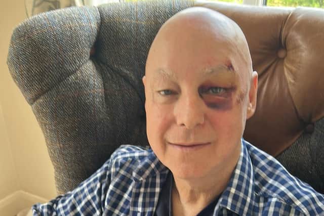 Robert Foster was attacked by a gull while walking his dog in Larkholme Parade, Fleetwood on Saturday (June 24)