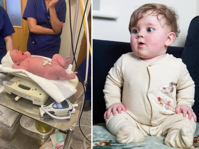 Teddie Eden just after being born (L) and pictured March 9, 2023 (R)